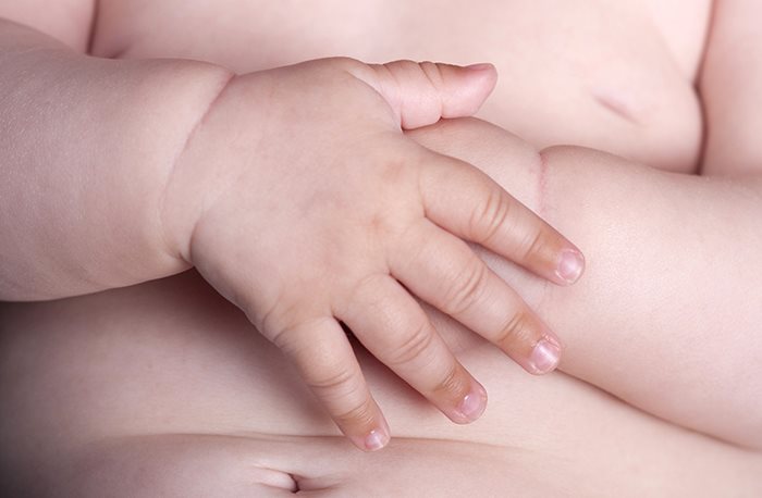 유아 물사마귀 치료, 중요한 핵심은?